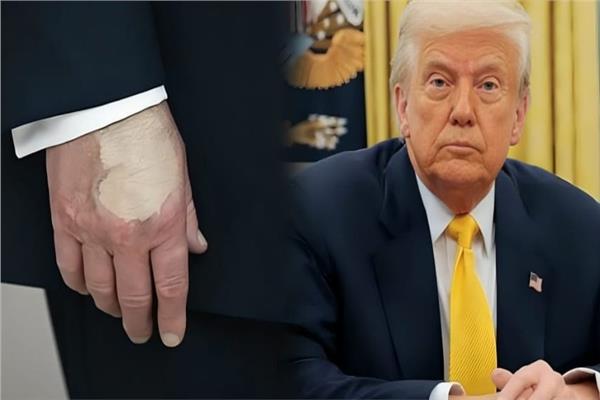 «وفاة ترامب».. هاشتاج يجتاح منصة إكس وسط غموض حول حالته الصحية| فما القصة؟