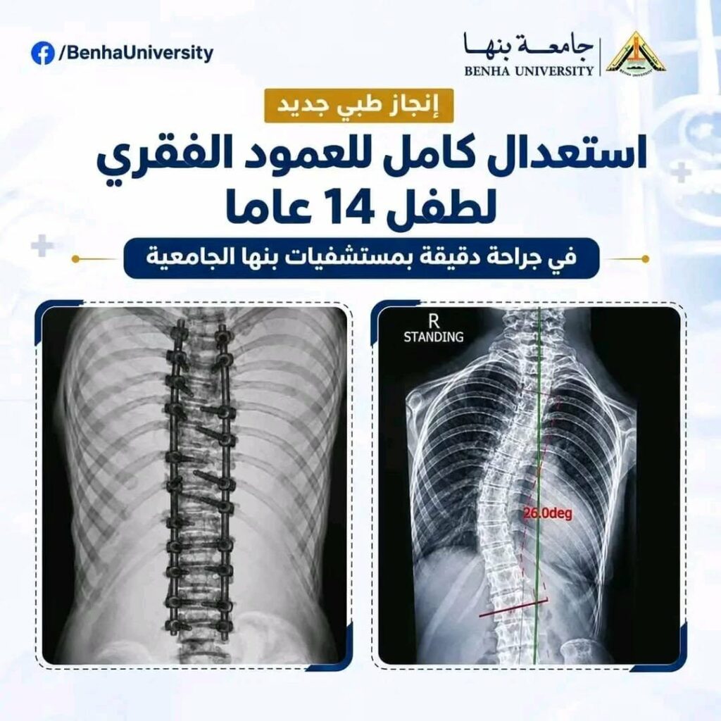 نجاح جراحة دقيقة تعيد استقامة العمود الفقري لطفل في مستشفيات جامعة بنها