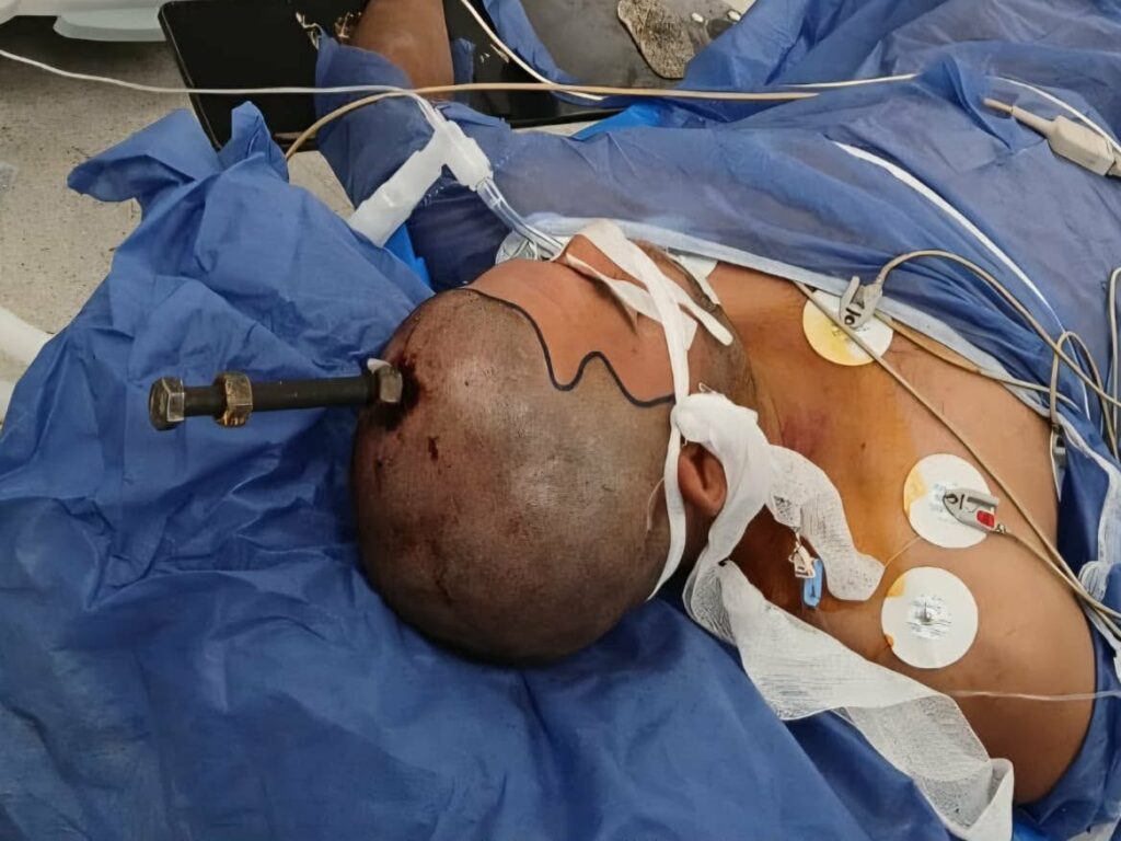 جراحة دقيقة استمرت 4 ساعات.. أطباء قصر العيني ينقذون مريضًا اخترق مسمار جمجمته